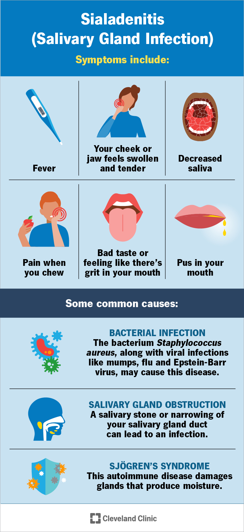 Sialadenitis symptoms include fever and jaw swelling; common causes include bacterial infection and salivary gland block