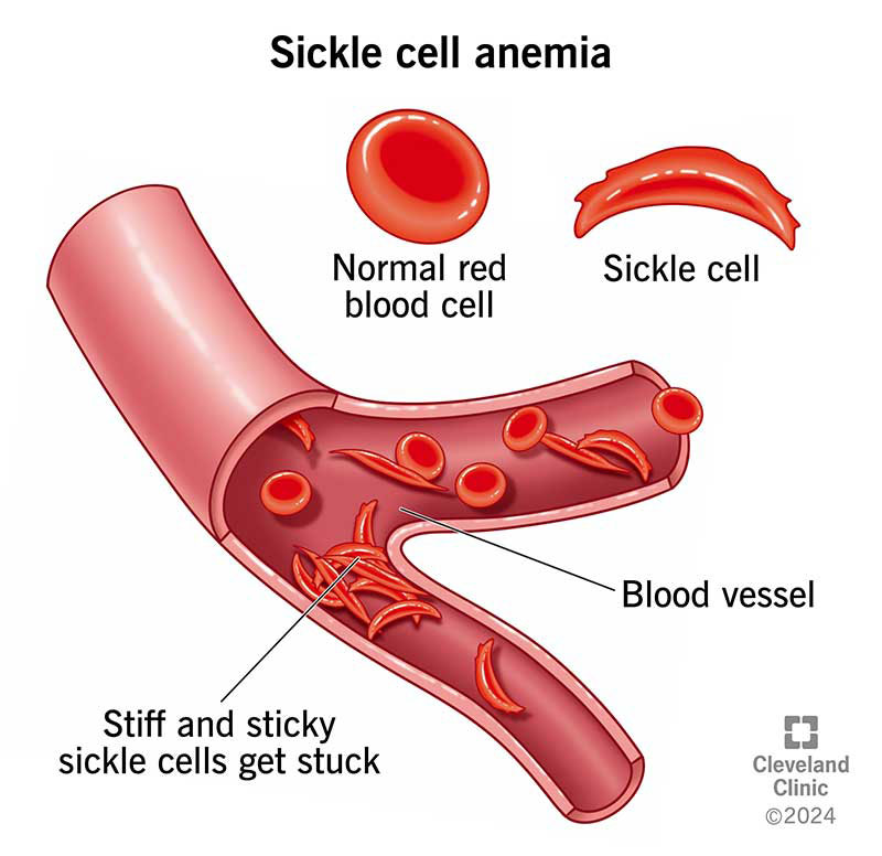 Sickle cell anemia, with sickle cells stuck in blood vessels, with normal red blood cells sliding through