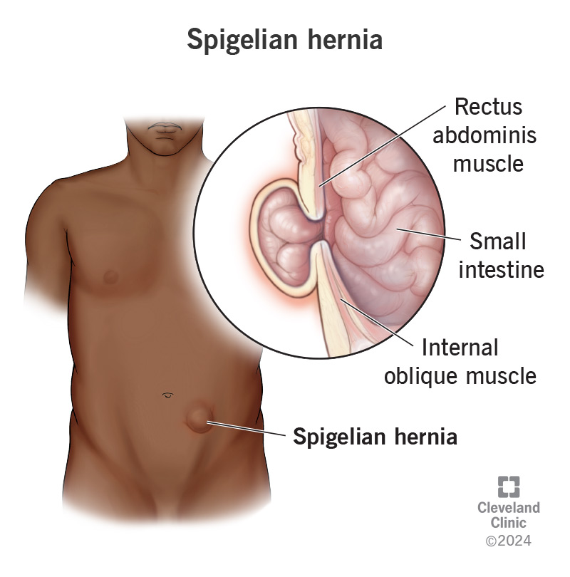 Spigelian hernias happen when your intestines slip out between weak abdominal muscles (inset).