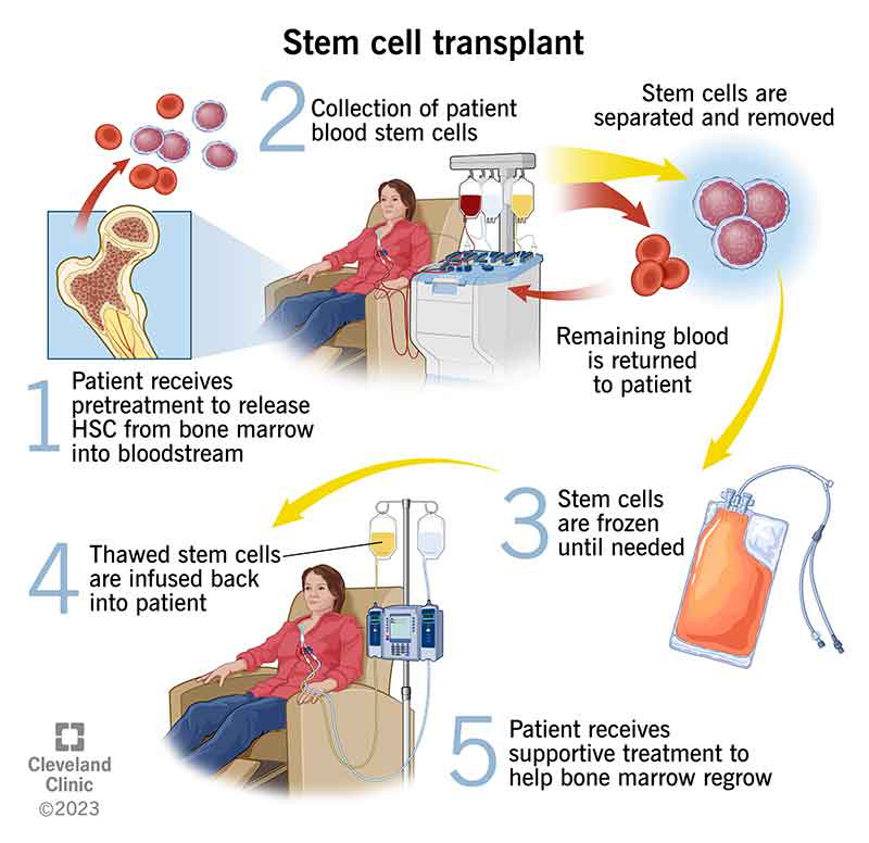Autologous stem cell transplant involves collecting and separating stem cells(1 & 2), storing them (3) before infusion (4).