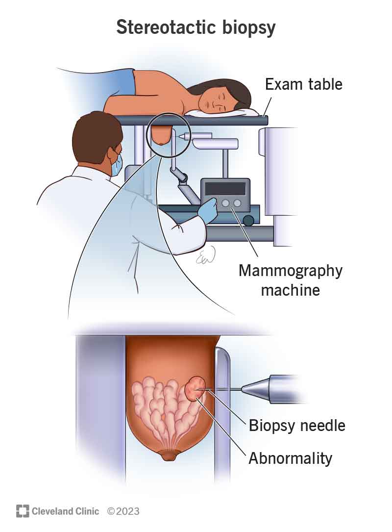 A person lying on a table during a stereotactic biopsy and a close-up of the biopsy needle removing tissue from the tumor.