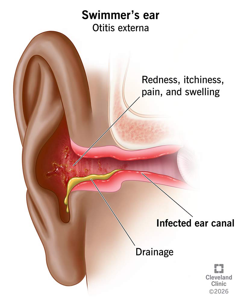 An infected ear canal with signs of swimmer’s ear, including redness, swelling and drainage