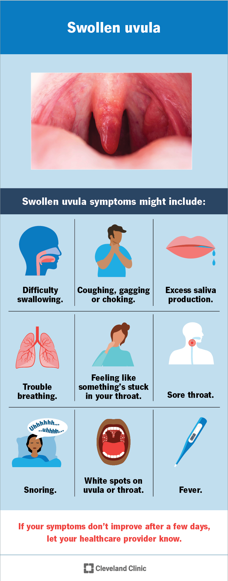 Swollen uvula followed by common uvulitis symptoms like difficulty swallowing, coughing, gagging, choking and excess saliva