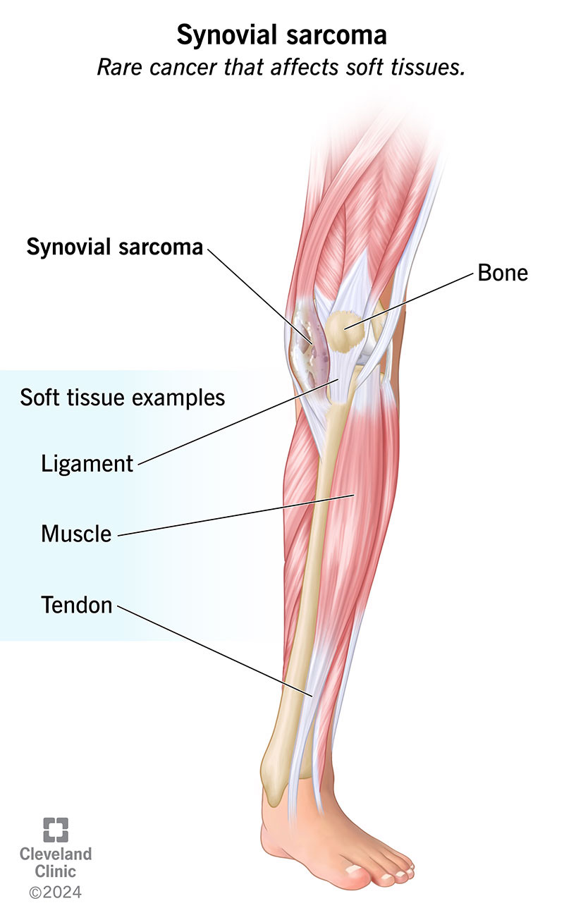 Synovial sarcoma in the knee's soft tissues, including ligaments, muscles and tendons.