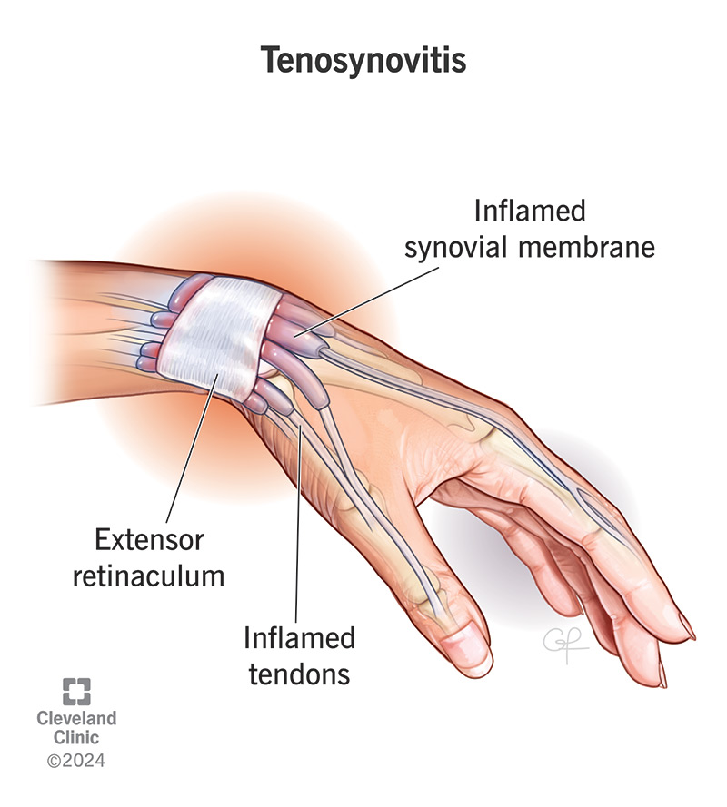 Wrist with inflammation of the synovial membrane (tenosynovitis)