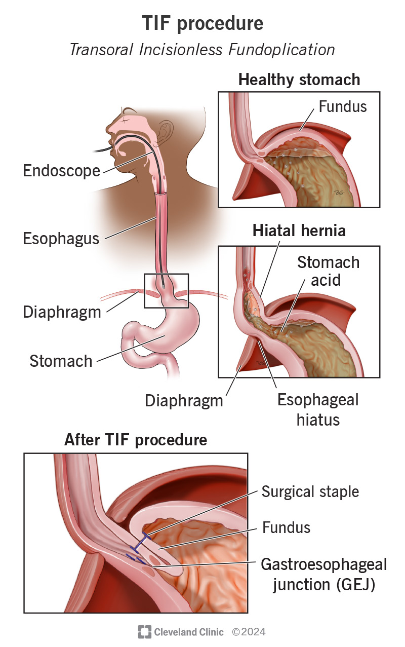 Diagram showing the TIF procedure and results.