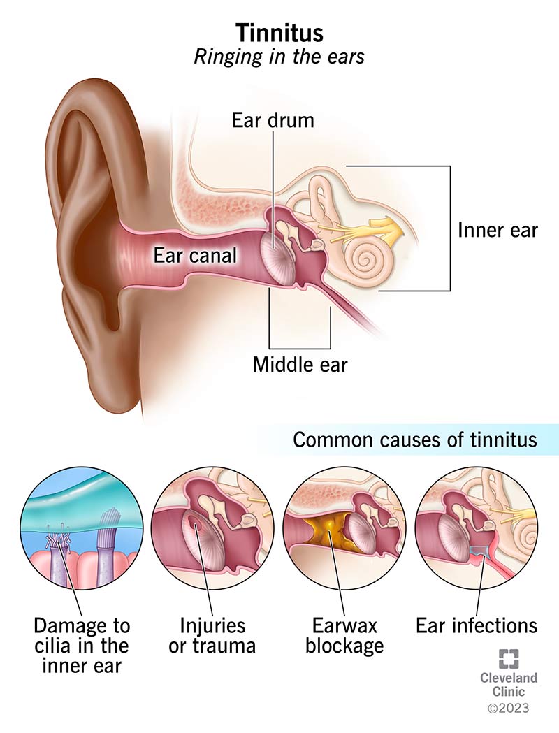 Outer, middle and inner ear anatomy and common tinnitus causes.