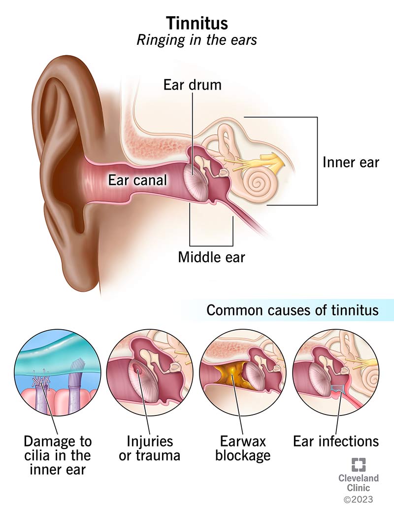 Tinnitus Ringing in Ears Causes Treatment