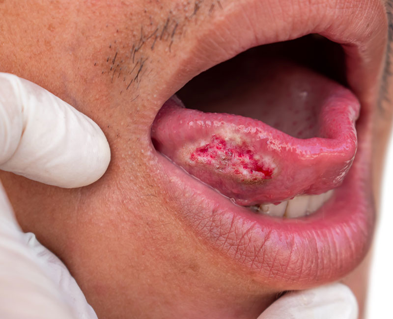 Tongue cancer lesion on underside of tongue