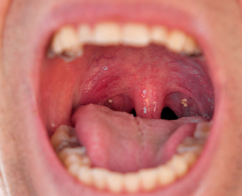 Open mouth with tonsil stones visible on both sides.