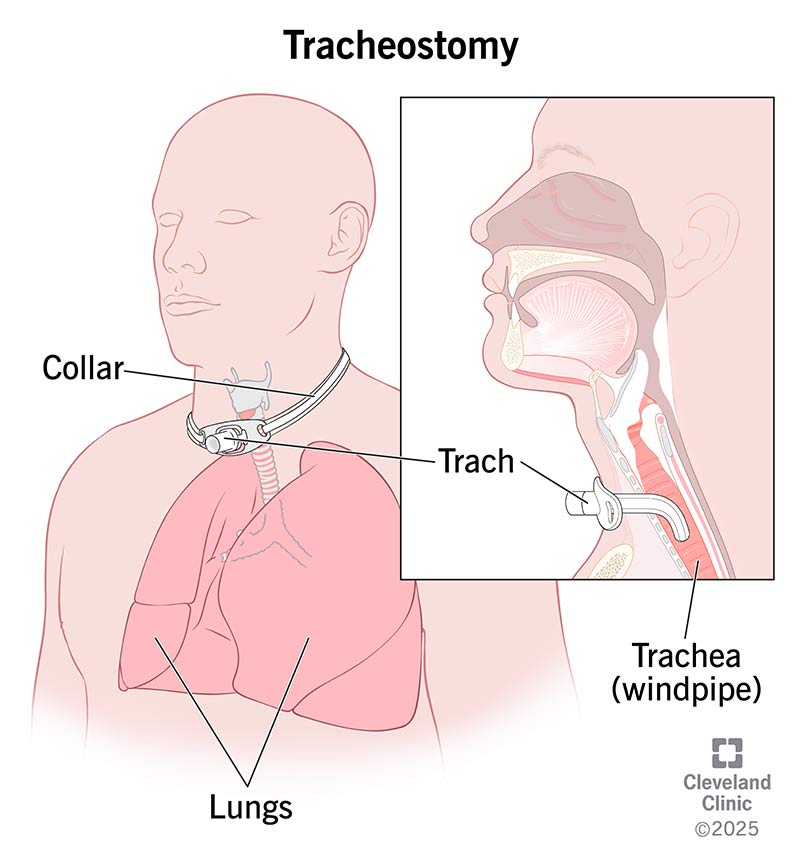 A trach tube extending into the trachea (windpipe) and held in place by a neck collar following a tracheostomy procedure