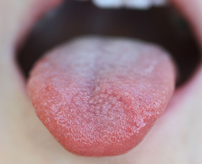 Blisters on deals back of tongue