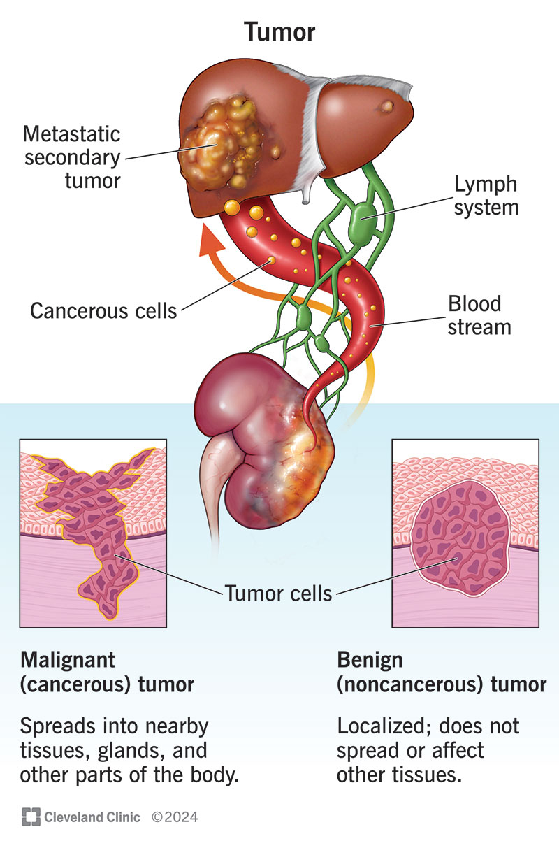 Cells in a benign tumor vs. a cancerous one, including the route cancer cells can take to form a secondary tumor