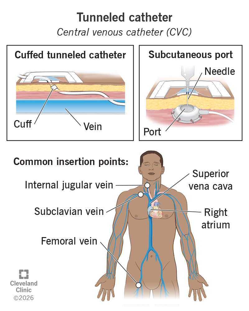 Two types of tunneled catheters, cuffed tunneled catheters and subcutaneous ports, and anatomy of common insertion points
