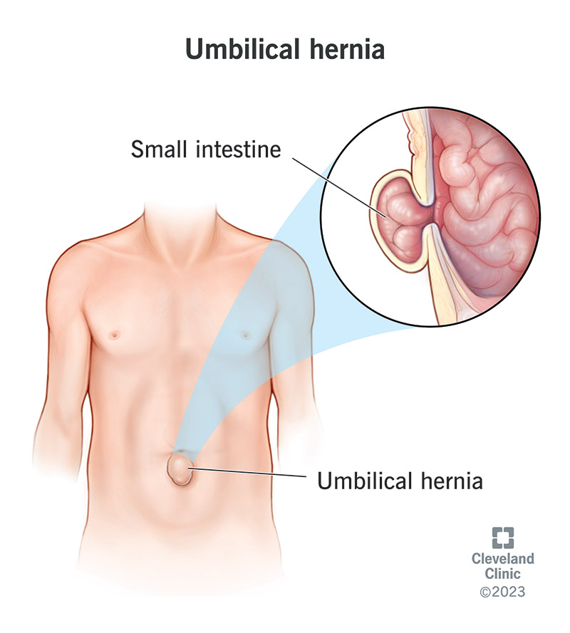 An umbilical hernia from the outside and from the inside, where the small intestine pokes through the abdominal wall.