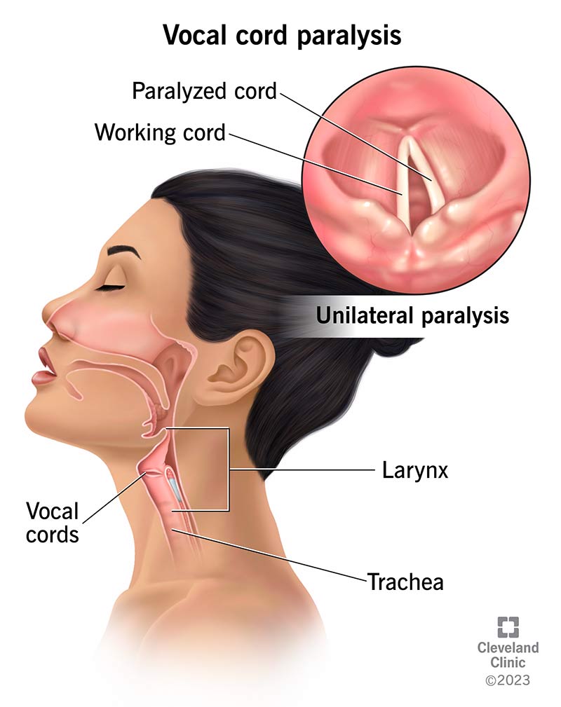 Fully functioning open and closed vocal cords compared to vocal cords with unilateral vocal cord paralysis