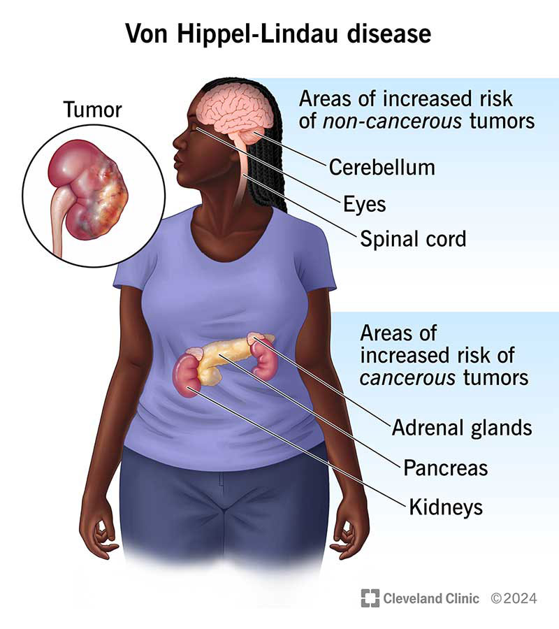 VHL increases your risk of cancerous tumors in adrenal glands pancreas and kidneys and non-cancerous tumors in brain and eyes