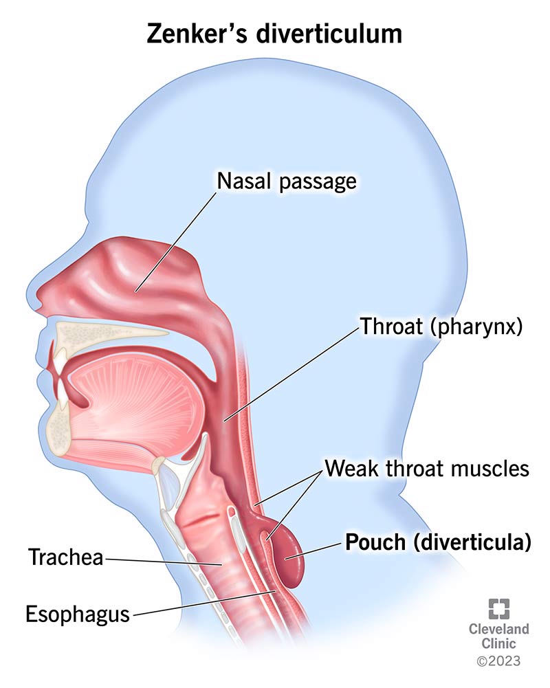 A Zenker’s divertula ( right) is a pouch in your pharynx upper right) where it meets your esophagus (lower right).