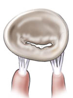 Stenosis Mitral