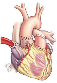 Die Aorta wird an das Autotransplantat und die Pulmonalarterie an das Homotransplantat angebracht – das Verfahren ist abgeschlossen.