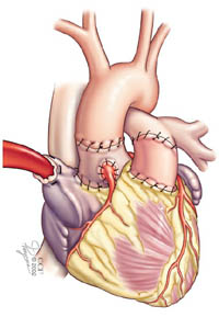 Aorta este atașată de autogrefă și artera pulmonară este atașată de homogrefă - procedura este completă.