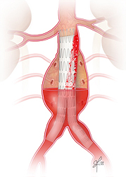 Endoleak Type 1