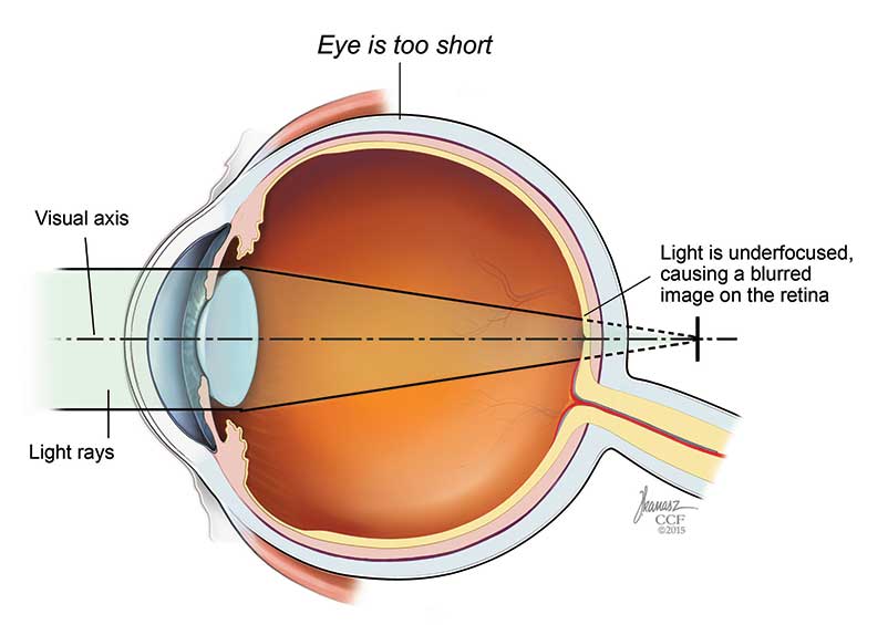 what makes a person near sighted