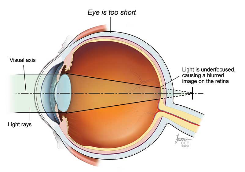 In hyperopia, the eye is short from front to back and the cornea is flatter than expected.