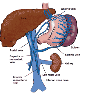 Distal Splenorenal Şant