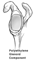 An illustration of the polyethylene glenoid component in the shoulder.