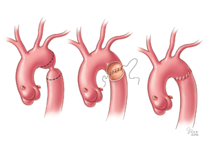 Aortic Coarctation Management And Treatment Cleveland Clinic