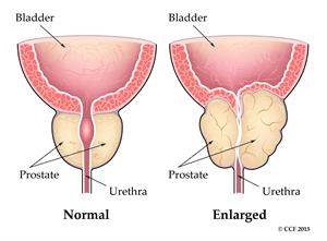 image of normal prostate and enlarged prostate