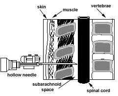 spinal tap, lumbar puncture, spinal cord, subarachnoid space, muscle, skin, hollow needle, vertebrae