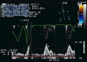 abnormal echocardiogram results