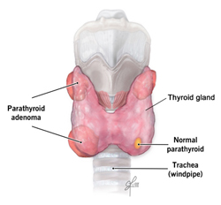 adénome sur parathyroïde