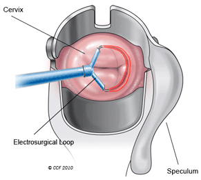 A frontal view of the cervix. The electrosurgical loop removes a thin layer of surface cells from the cervix.