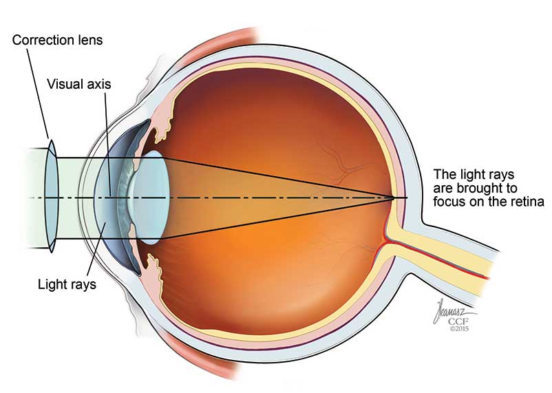 Vision corrigée