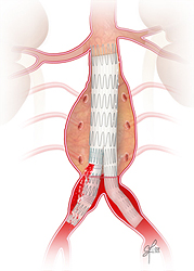 Endoleak Type 3 with leak from overlapping segments