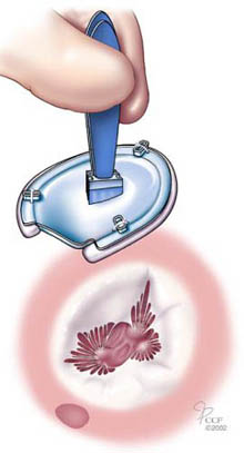 Edwards MC 3 Anüloplasti Sistemi