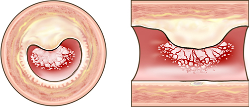 Heart Attack: Thrombolytic medications are used to break up clots blocking the artery