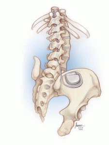 Inset Pain stimulation illustration
