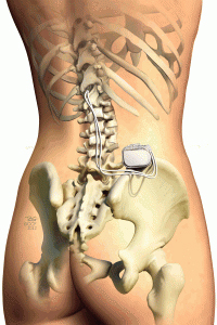 Neurostimulator in Thoracic Spine illustration