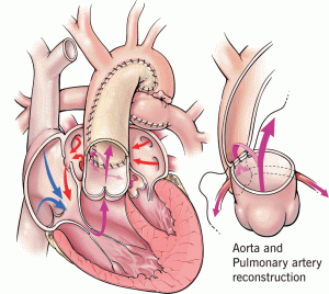 aorta and pulmonary artery reconstruction illustrations
