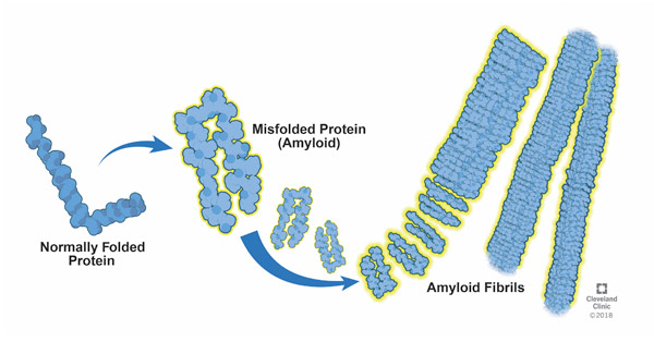 Formation of Amyloidosis