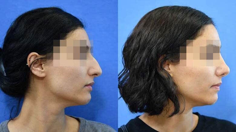 Before and after Rhinoplasty treatment at Cleveland Clinic.