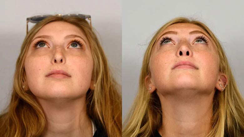 Before and after Rhinoplasty treatment at Cleveland Clinic.