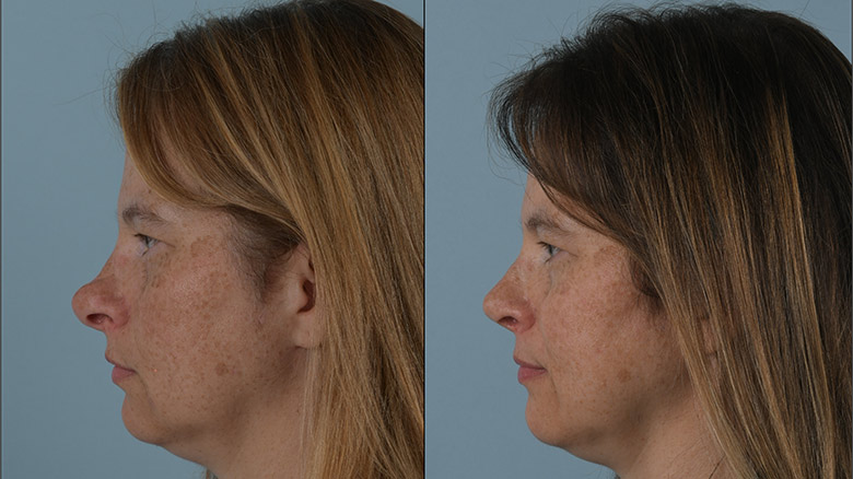 Side profile before (left) and after (right) rhinoplasty procedure.