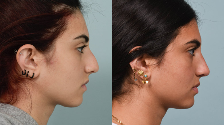 Rhinoplasty before (left) and after (right) at Cleveland Clinic.