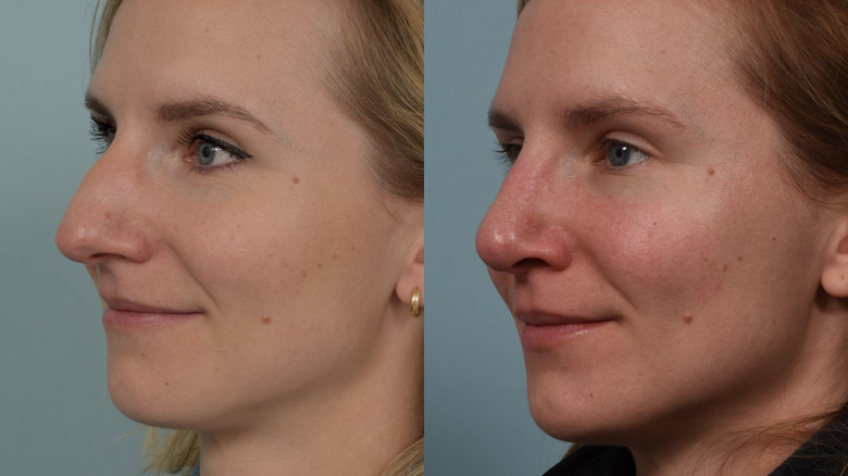 Rhinoplasty before (left) and after (right) at Cleveland Clinic.