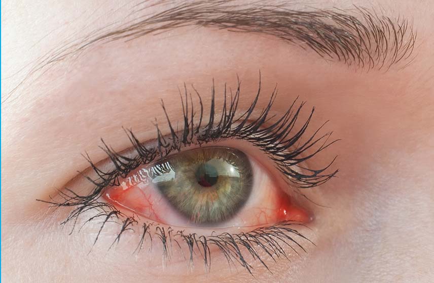 Close-up of an eye diagnosed with uveitis, appearing red, irritated and swollen.